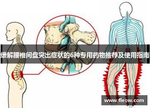 缓解腰椎间盘突出症状的6种专用药物推荐及使用指南